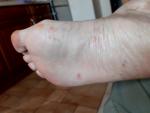 Сыпь на стопах ног фото 2