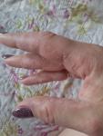 Сухая кожа рук, шалушение и трещины фото 3
