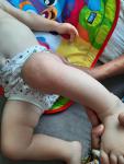 Сыпь на колене у ребенка в год фото 1