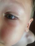 У ребенка в нижнем углу глаза пузырь фото 5