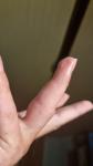 Отек пальца после пореза и ношения лангета фото 3