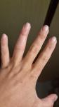 Отек пальца после пореза и ношения лангета фото 4