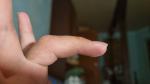 Отек пальца после пореза и ношения лангета фото 5