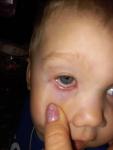 Покраснение глаза у ребенка фото 1