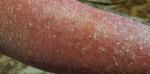 Сильное воспаление кожи, краснота и температура фото 3