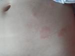 Красные пятна на теле у ребенка после заболевания СД 1 ТИПА фото 4
