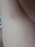 Красные пятна на теле у ребенка после заболевания СД 1 ТИПА фото 2