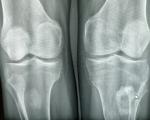 Расшифровка рентгена коленного сустава фото 1