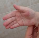 Красная кожа рук у ребёнка (похожие на язвочки) фото 1