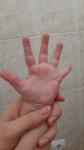 Красная кожа рук у ребёнка (похожие на язвочки) фото 2