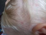 Непонятное пятнышко на голове у ребенка фото 2