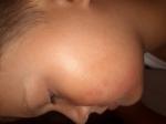 Высыпания на щеках у ребёнка фото 1