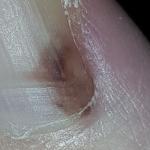 Темно-коричневое пятно на большом пальце ноги фото 1