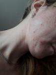 Проблемы с кожей лица, раздражение, болезненность, краснота фото 1