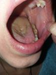 Жжение и воспаление языка фото 5