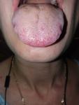 Жжение и воспаление языка фото 4