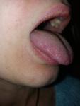 Жжение и воспаление языка фото 3