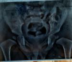 Рентген тбс ребенку 1 год фото 2