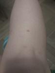 Дерматофибромы на ногах фото 1