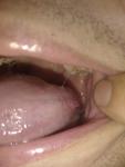 Подозрение на рак языка-полости рта фото 1