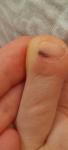 Тёмное пятно на ногте пальца ноги фото 2
