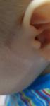 Пятно синее в ухе у грудничка фото 4