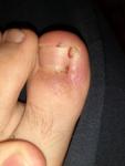 Рана на большом пальце ноги красная шишка фото 1