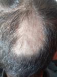 Резкое выпадение волос без явных причин фото 1
