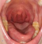 Уже около месяца увеличена миндалина с одной стороны в горле фото 2