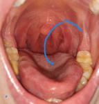 Уже около месяца увеличена миндалина с одной стороны в горле фото 1