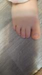 Палец на ноге у ребенка вывернут во внутрь фото 2
