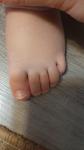 Палец на ноге у ребенка вывернут во внутрь фото 5