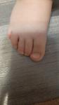 Палец на ноге у ребенка вывернут во внутрь фото 3