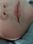 Пятно под носом у ребенка 1 год и 2 месяца фото 1