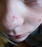 Сыпь на лице ребёнка фото 1