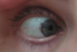 Кровоизлияние на белке глаза. Рак глаза фото 2