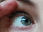 Кровоизлияние на белке глаза. Рак глаза фото 1