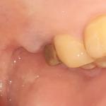Гемостатическая губка в лунке зуба фото 1