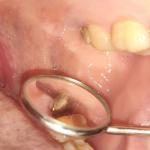 Гемостатическая губка в лунке зуба фото 2