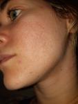 Сыпь на щеках после лечения акне фото 1