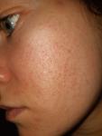 Сыпь на щеках после лечения акне фото 2