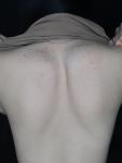 Высыпание на спине и грудной клетке фото 3