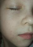 Герпетическая сыпь на лице у ребёнка фото 3