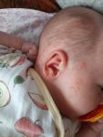 Акне новорожденных или аллергия фото 3
