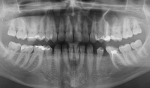 Обломок инструмента в зубном канале фото 1
