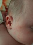 Акне новорожденных или аллергия фото 2