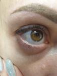 Желтое пятно на белке глаза фото 1
