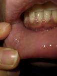 Жжение, боль припухлостей в слизистой нижней губы фото 1