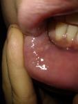Жжение, боль припухлостей в слизистой нижней губы фото 3
