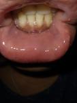 Жжение, боль припухлостей в слизистой нижней губы фото 4